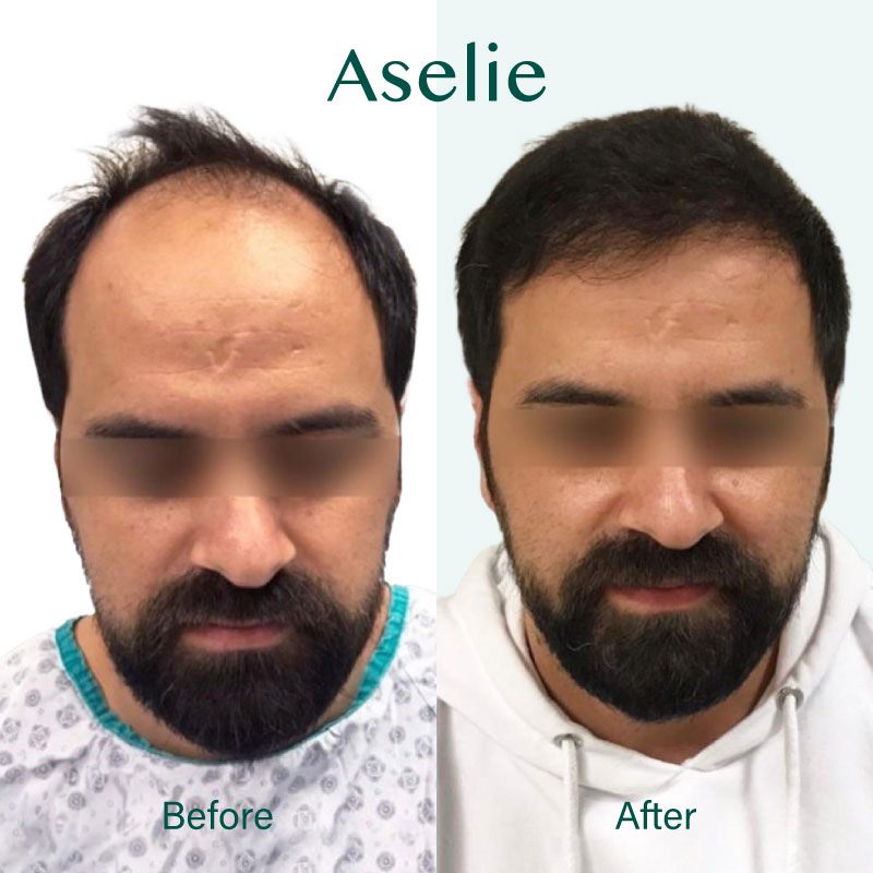 Hair Transplant in Istanbul 06