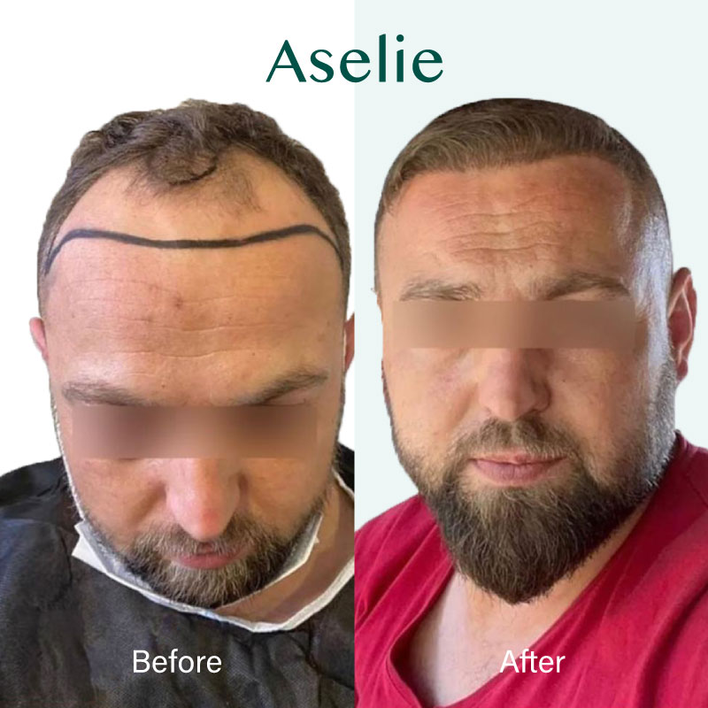 Hair Transplant in Turkey 01