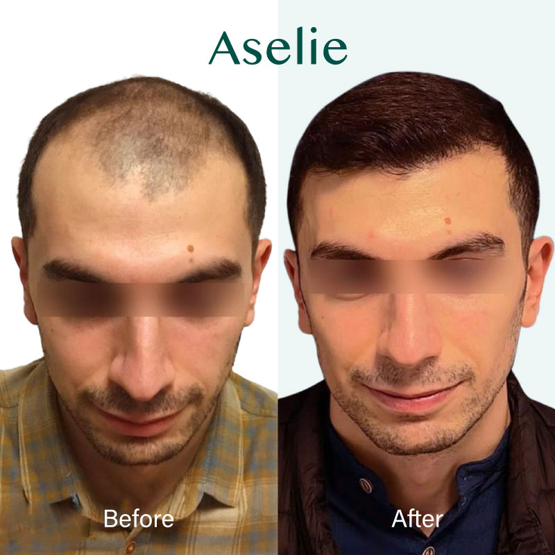 Hair Transplant in Turkey 03