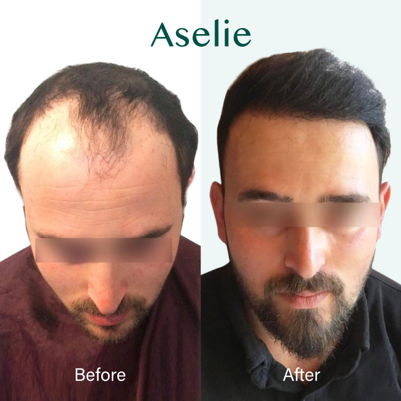 Hair Transplant in Turkey 04