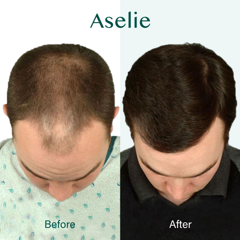Hair Transplant in Turkey 05
