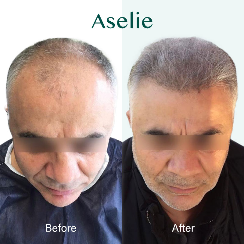 Hair Transplant in Turkey 07