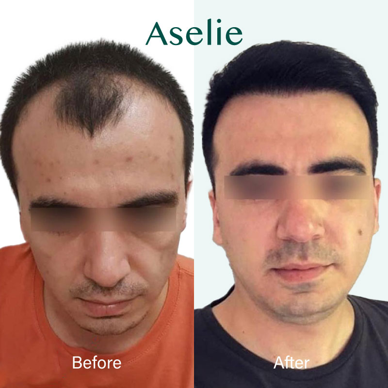 Hair Transplant in Turkey 08
